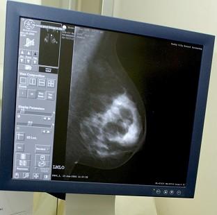 Congleton Guardian: More women under the age of 50 are being diagnosed with breast cancer, data suggests Congleton Guardian: More women under the age of 50 are being diagnosed with breast cancer, data suggests